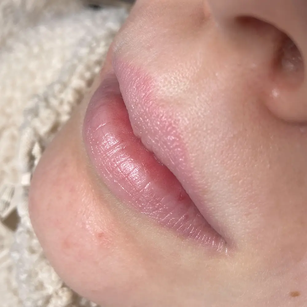 Usta przed zabiegiem lip blush — naturalny, blady odcień